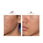 میکرودرم خانگی گلویش استایل مدل MP-29